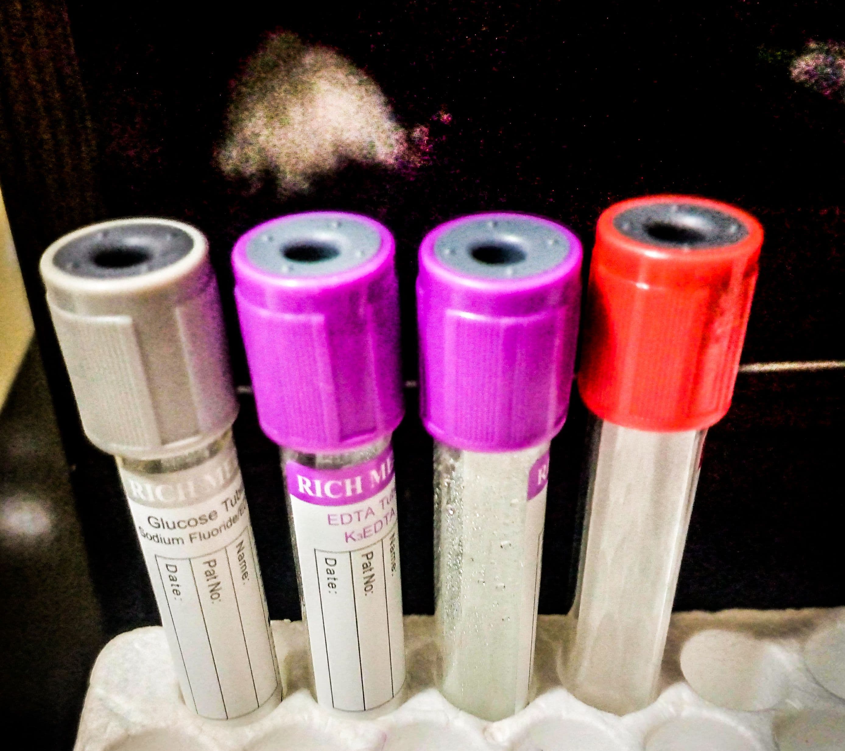 Clinical chemistry blood sample tubes in a medical laboratory
