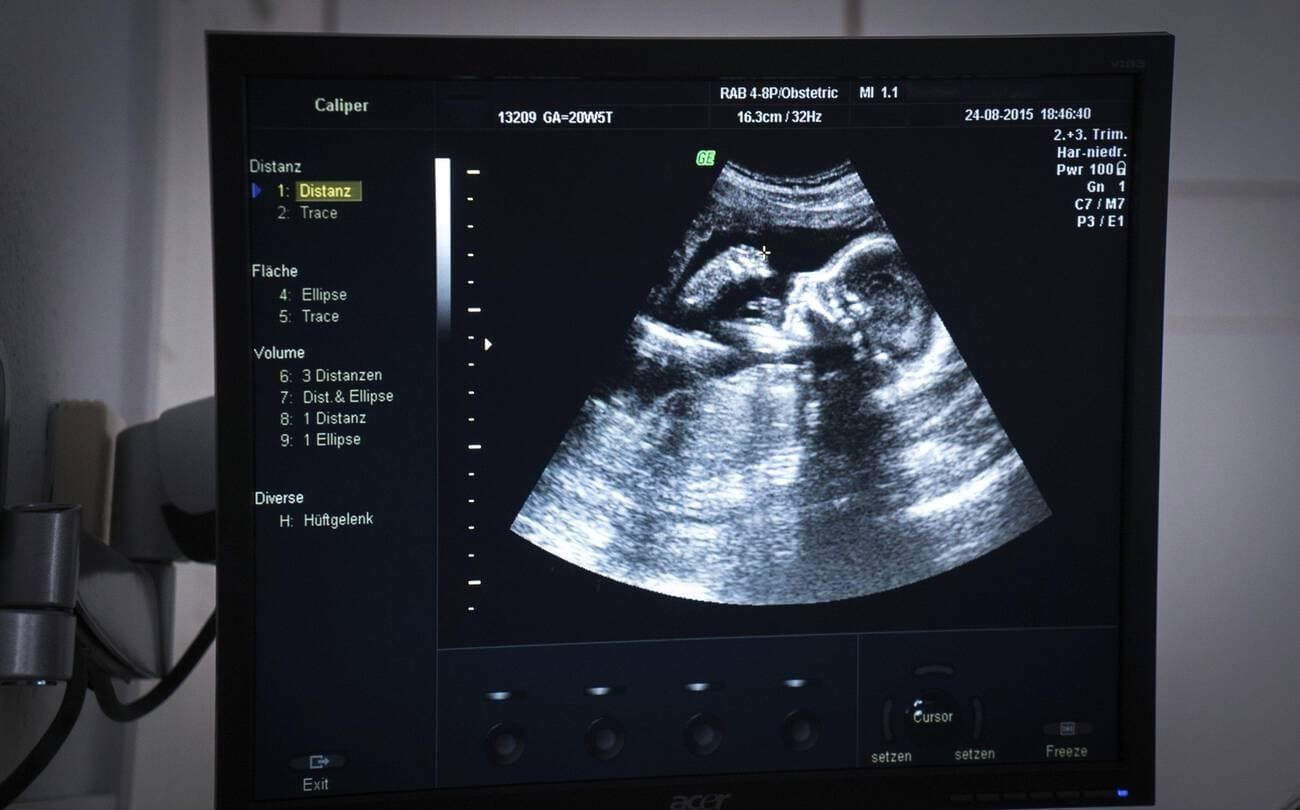 Obstetric ultrasound scan on a diagnostic monitor